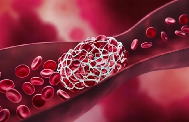 طرق الوقاية من جلطات الدم