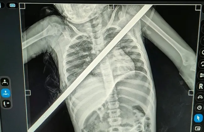 إنقاذ حياة طفلة اخترق سيخ حديد صدرها فى بنها الجامعى بعد  3 ساعات فى العمليات